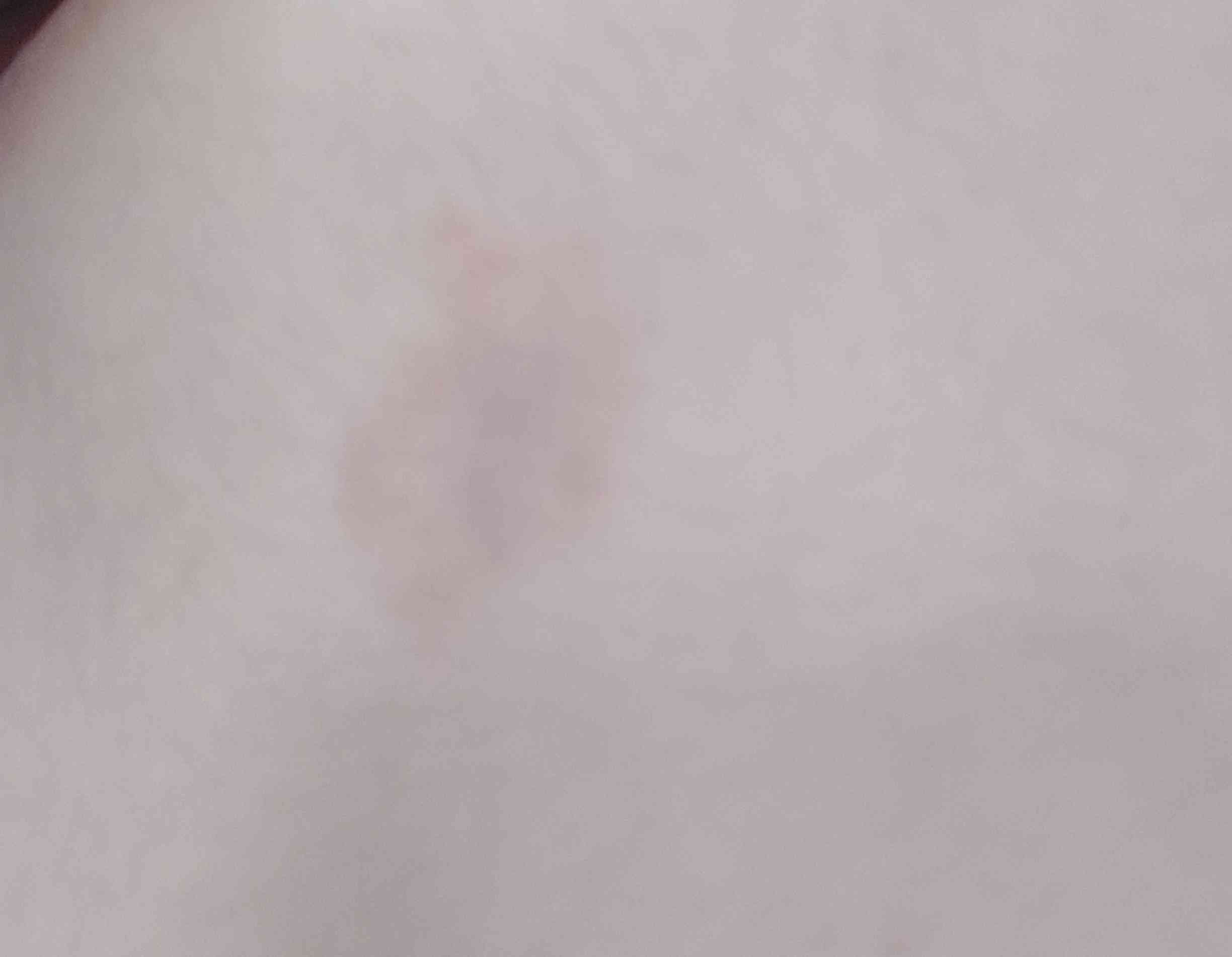 بچه ها لطفا بهم بگین این چه نوع بیماری هست یا امکان داره حشره ای باشه از چه نوع و تا چه مدت ادامه داره و از چه دارویی استفاده کنم لطفا جواب بدین 